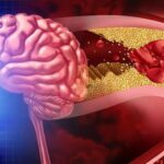 İnme ile Yeniden Doğuş: ‘Milattan Önce ve Sonrası Gibi’ Deneyimler!