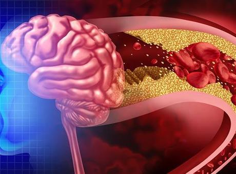 İnme ile Yeniden Doğuş: ‘Milattan Önce ve Sonrası Gibi’ Deneyimler!